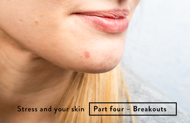 Stress and Your Skin Series - Part 4 - Breakout