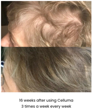 LED FOR HAIR GROWTH BEFORE & AFTER