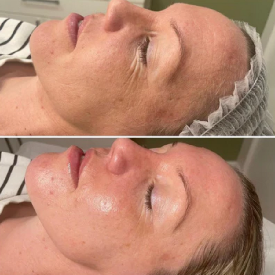 Signature Lift Peel