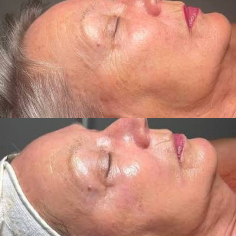 Signature Lift Peel