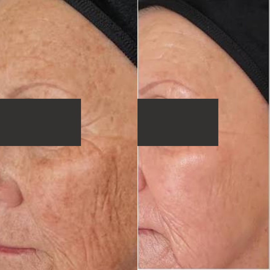 A-Zyme Peel Treatment