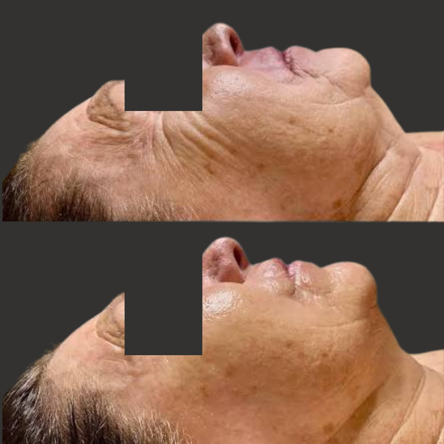 A-Zyme Peel Treatment