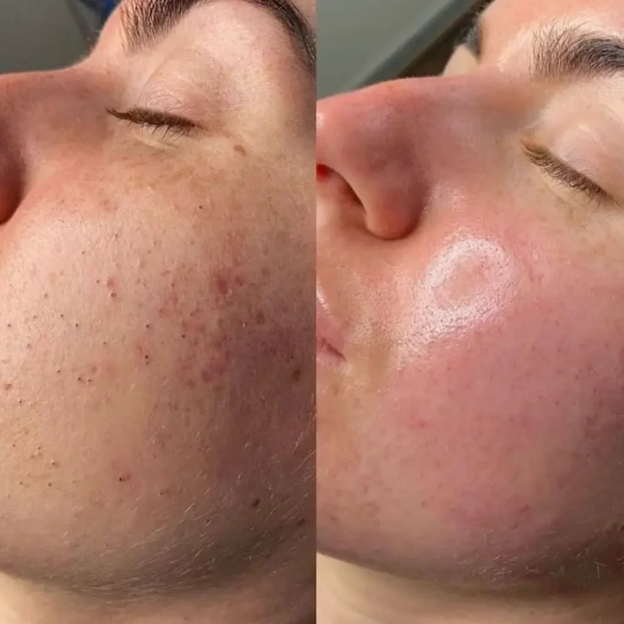 HydraFacial®