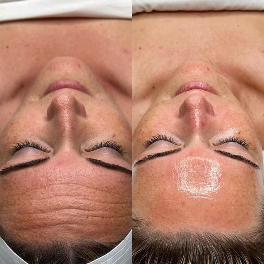 HydraFacial®