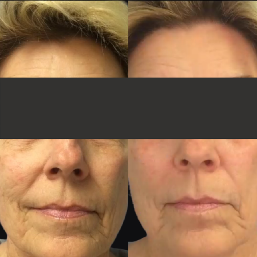 LED Light Therapy
