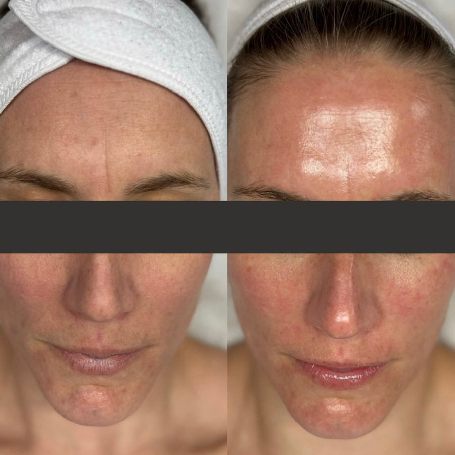 O2 Lift Facial