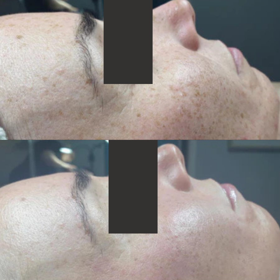 O2 Lift Facial