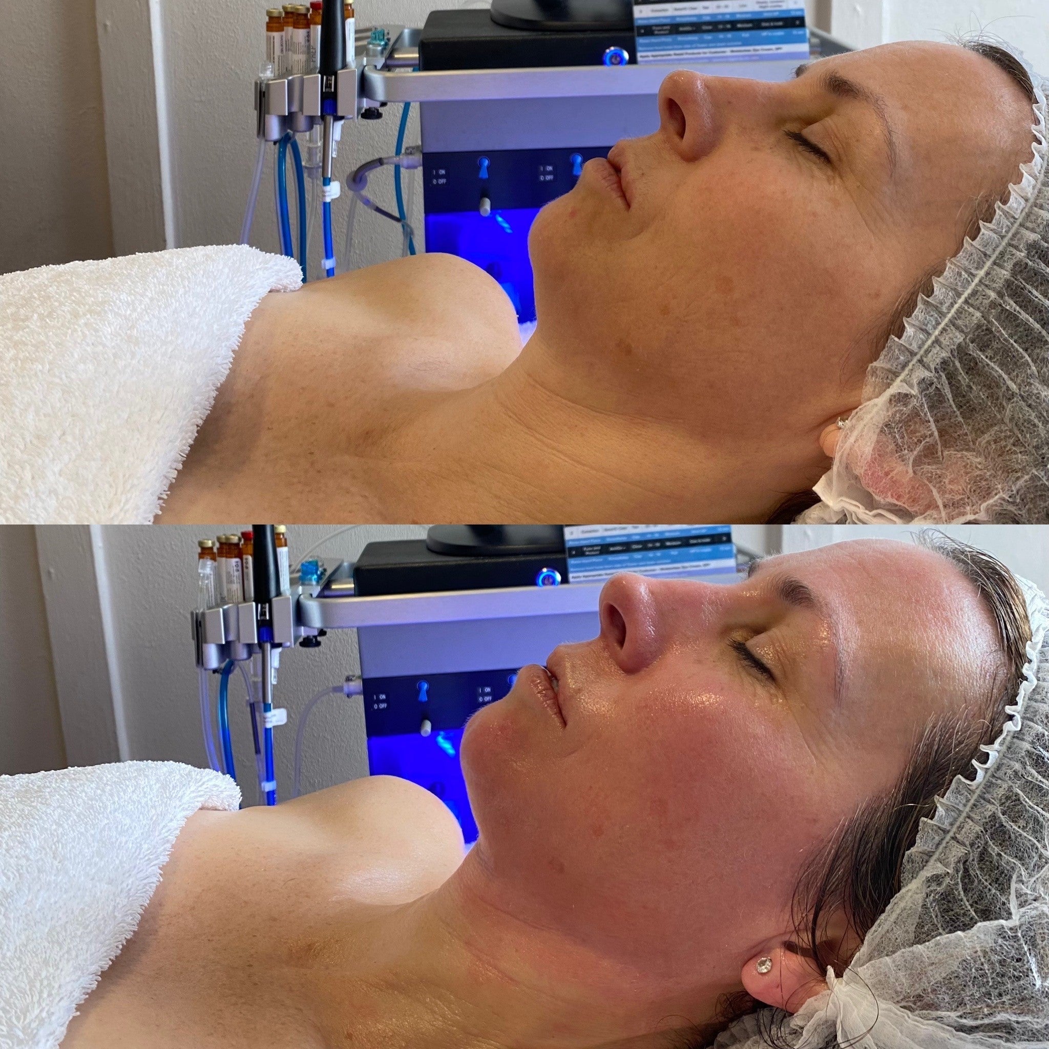 HydraFacial Platinum