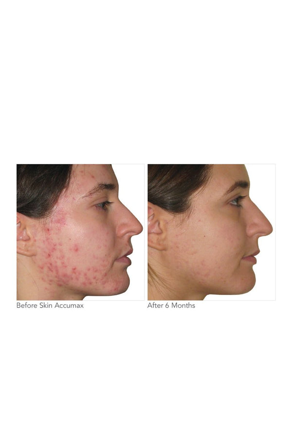 Skin Accumax™ 180