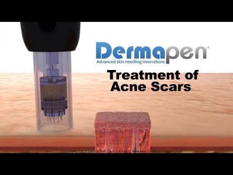 Dermapen - Microneedling